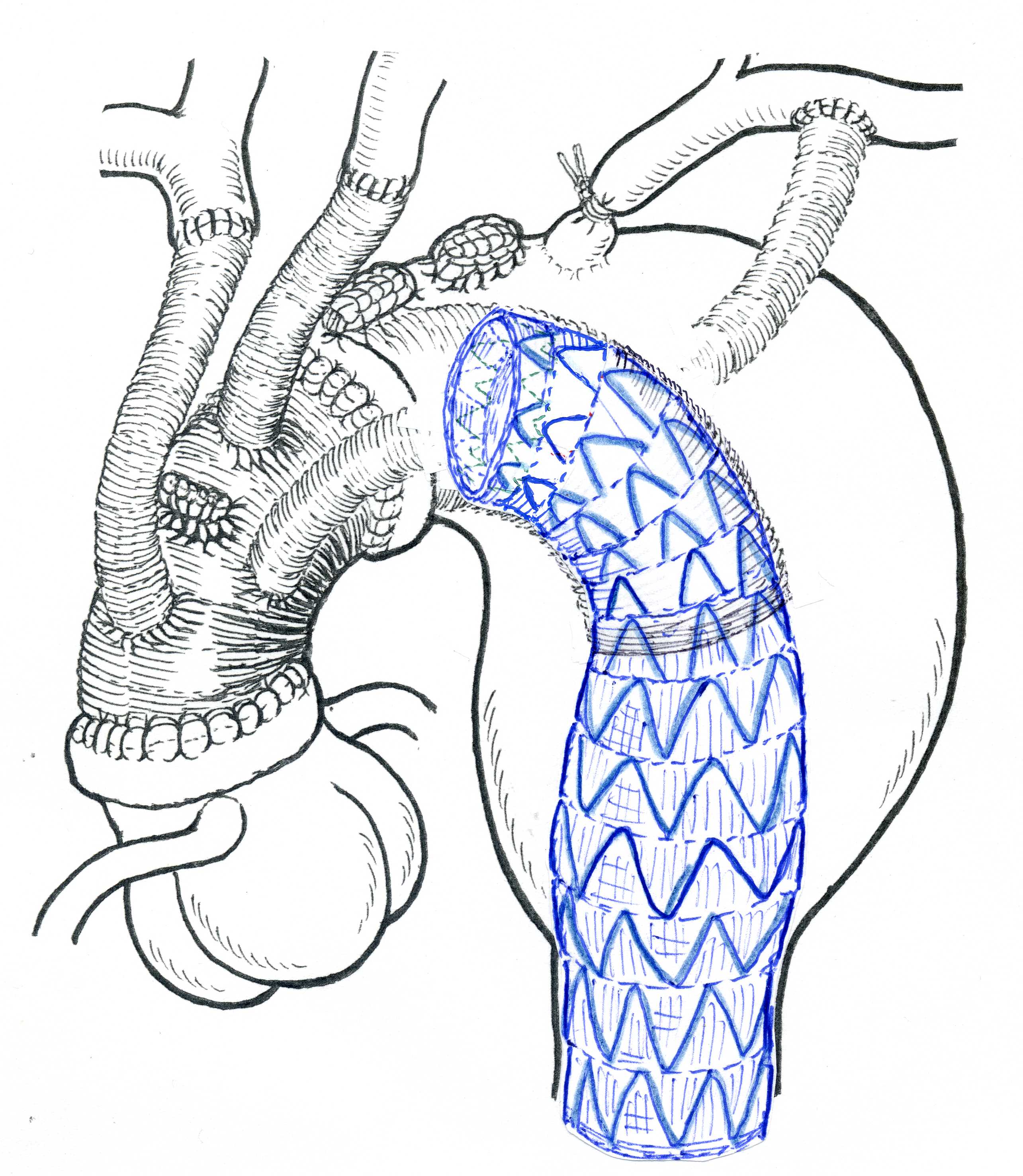 胸部大動脈瘤とハイブリッド手術名古屋大学附属病院ハートチーム