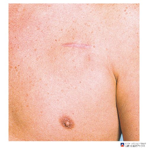 不整脈チーム 皮下植込み型除細動器 S-ICD– 岐阜ハートセンタ