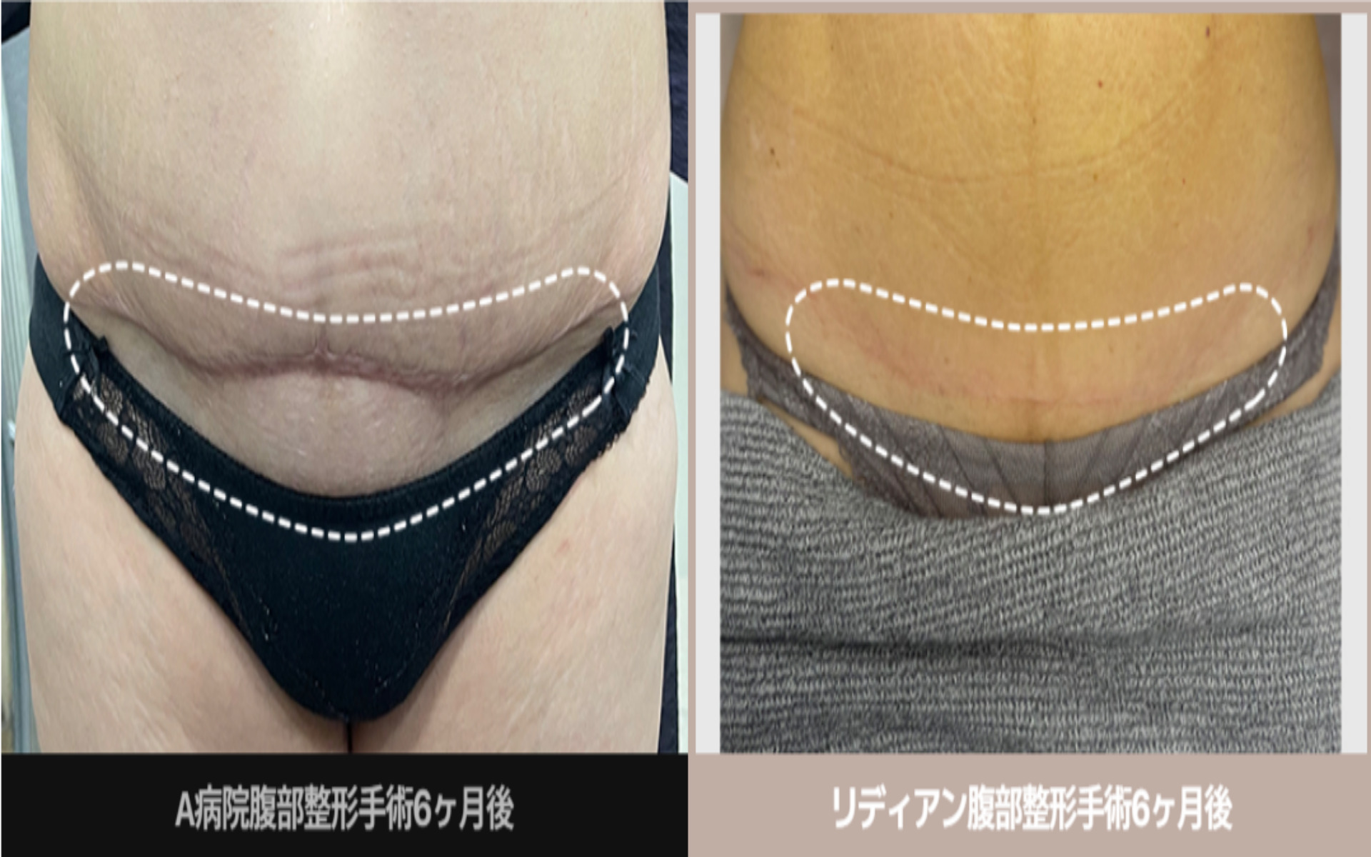 産後ママはお腹のたるみが気になる！戻らない原因と対応について - teniteo テニテオ