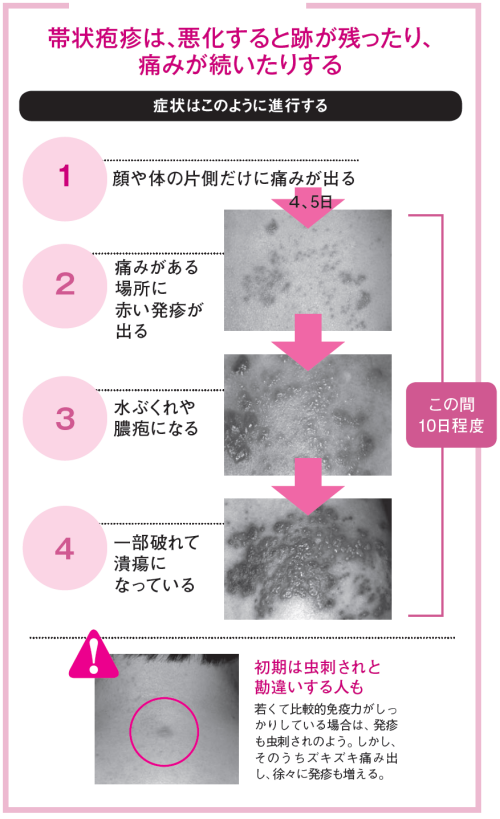 突発性発疹による不機嫌はいつまで続く？ひさとみこどもクリニック