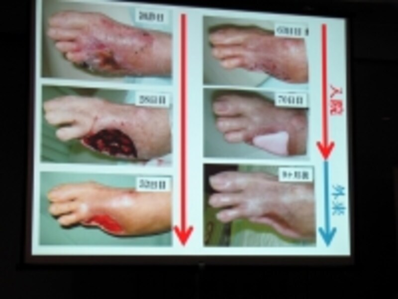 尿病で足切断」とならないために〜 糖尿病が及ぼす足の神経障害 〜甲状腺・糖尿病・生活習慣病・睡眠時無呼吸新宿金沢内科クリニック