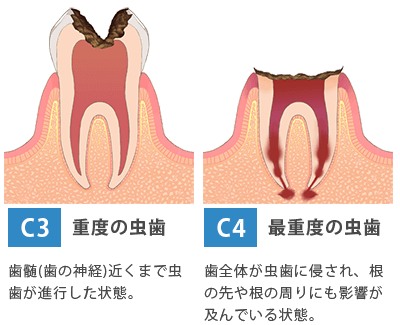 虫歯で歯茎が腫れた！？原因と即効性のある対処法ザ・ホワイトデンタルクリニック 歯医者・歯科