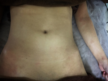 アトピー性皮膚炎による 「掻きむしり跡」と「色素沈着」 5回終了後の症例Cocotiiココティー グリーンピール グランプリ連続受賞!!ニキビ、サメ肌、しみ、しわ、くすみなら肌ケアサロンCocotii