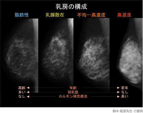 マンモグラフィについて乳腺外科・マンモグラフィ・乳がん検診・乳腺専門医・大阪府高槻市・りょうクリニックHP