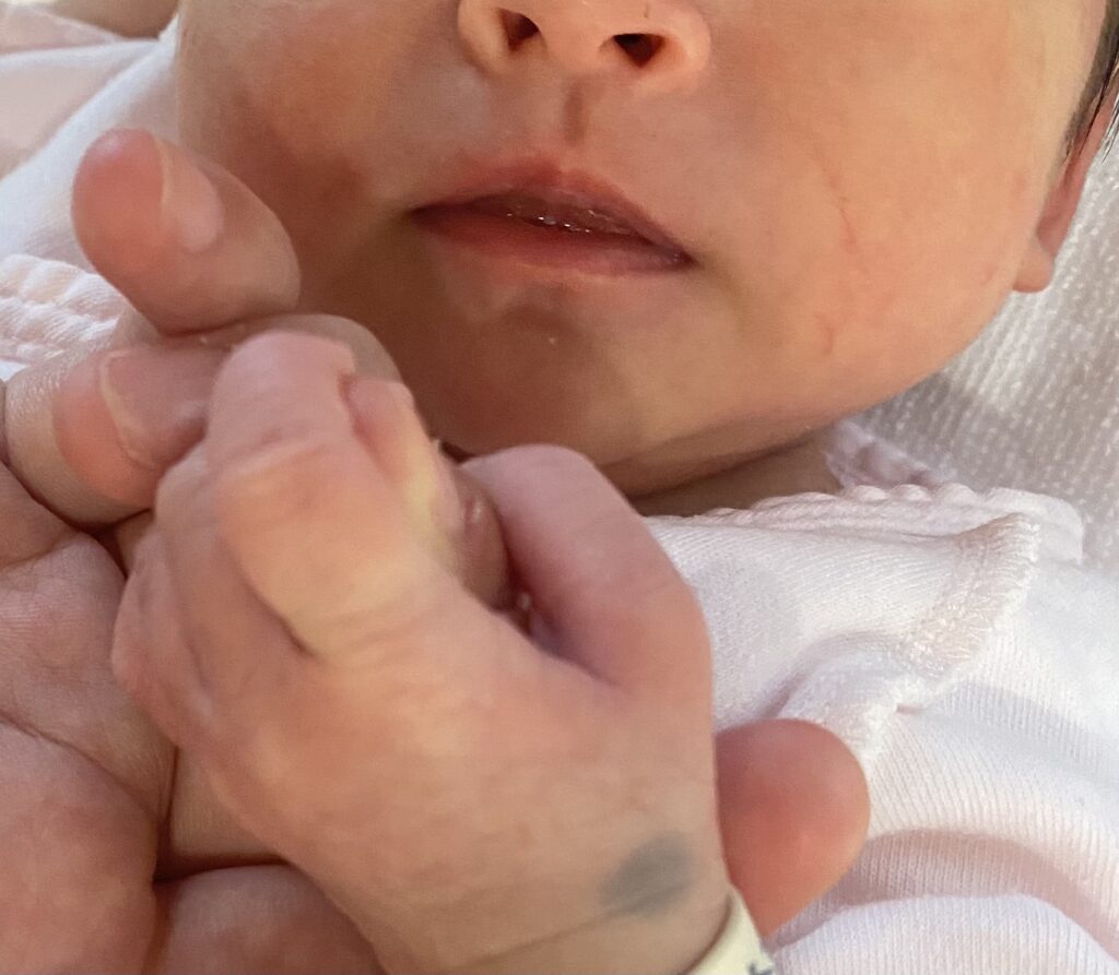 異所性蒙古斑の3回目のレーザー治療に﻿ 行ってきました。詳しくはブログにも✍️﻿ ﻿ 治療の情報を探している方の﻿ 役に立てばいいな～と思い、﻿ ﻿検索にひっかかりやすいように﻿ インスタにも載せておきます。﻿ ﻿ 2枚目が、レーザー治療前と、﻿ 今朝 レーザー2回照射後