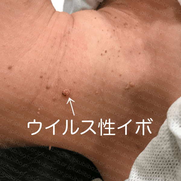 顔・首・体の多発いぼを1回で一括除去スキャナ付CO₂レーザー 山手皮膚科
