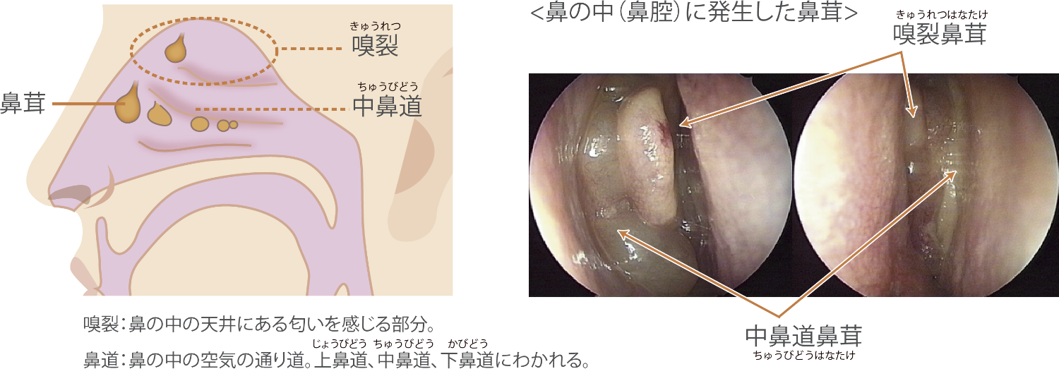 気づきにくい鼻のがん 喫煙や粉じん 原因にヨミドクター 読売新聞