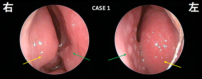 OHNCC 岡山大学病院頭頸部がんセンター各種頭頸部がんの解説