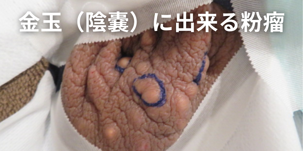 粉瘤 アテローム の治療なら池袋駅前のだ皮膚科へ原因や見分け方・治療方法などについて