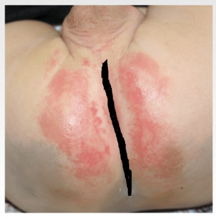 虫刺され 『ダニ』に刺されたらどうすれば？症状、対策、予防法を解説田辺三菱製薬ヒフノコトサイト