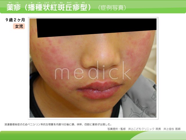 多型性滲出性紅斑野田市 小児科 千葉県 こどもの花粉症 こどもの漢方 喘息 アトピー性皮膚炎 アレルギー 結節性痒疹 たんぽぽこどもクリニック