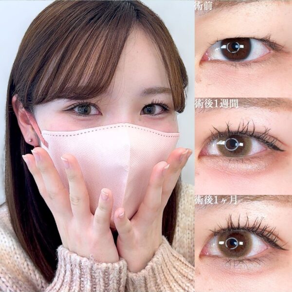 埋没法後の内出血はひどい？いつまで続く？経過や治らない場合にできることを解説 – エックスクリニックX CLINICエイジングケア・クマ治療、二重整形など・美容皮膚科・審美歯科