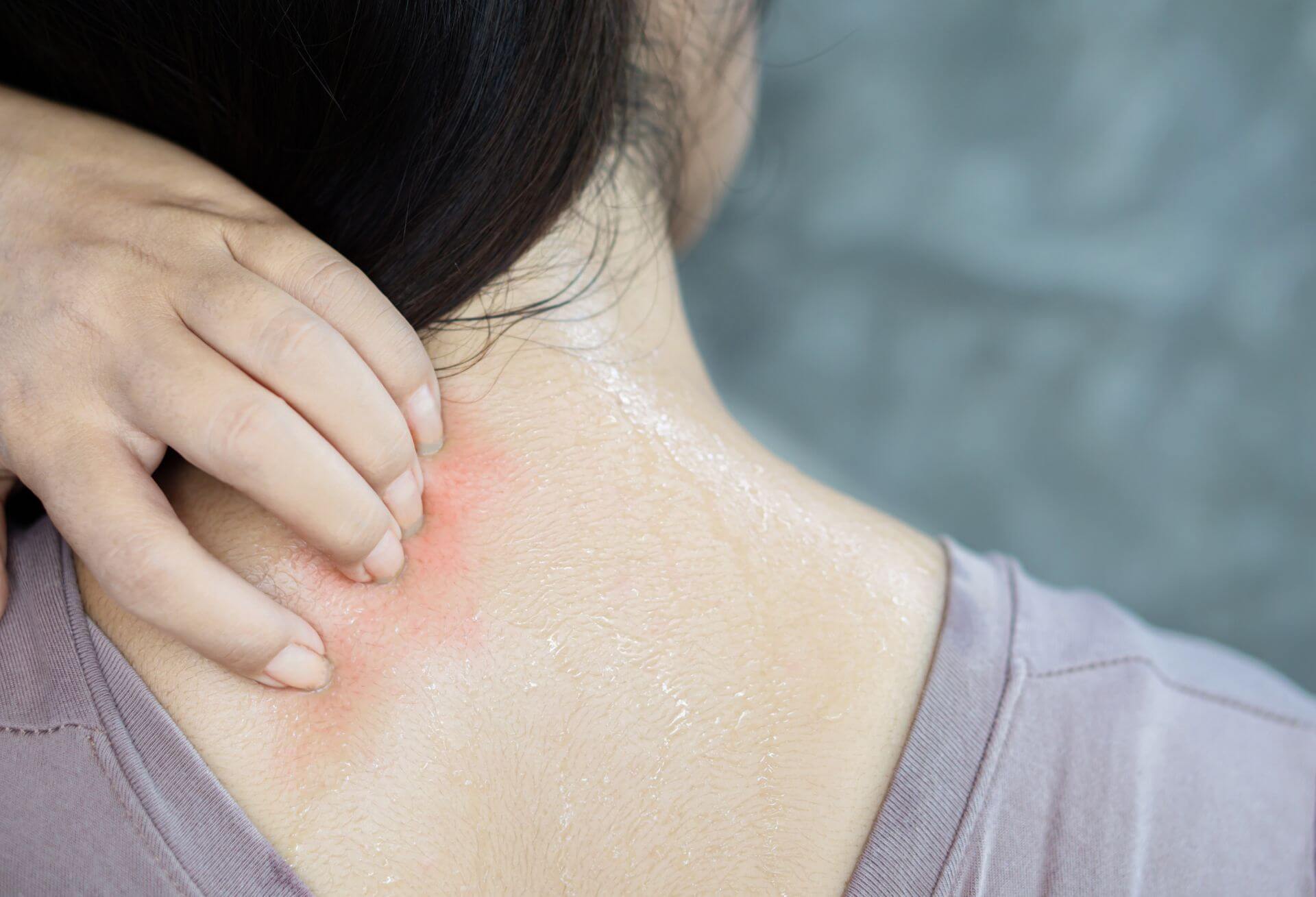 赤ちゃん・子どものあせも 原因・症状・治療法⾚ちゃん・⼦どもの肌トラブル情報館池田模範堂