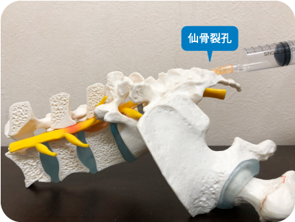 仙骨裂孔 - e-Anatomy - IMAIOS