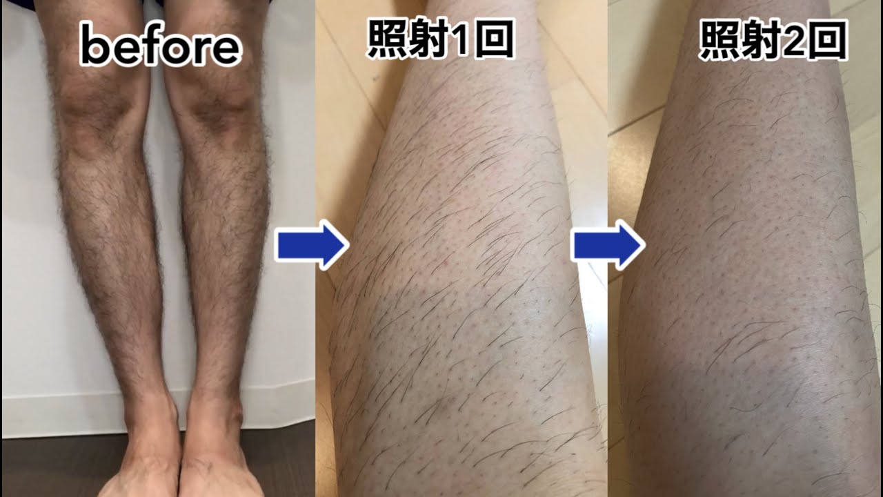 男性の脚，足 メンズワックス脱毛 東京新宿サロン東京新宿駅5分男性スタッフメンズ光脱毛・メンズブラジリアンワックス脱毛・スプレータンニング・ジュラシック筋膜リリース・ハリウッドブロウリフト眉毛サロンのLuxyBronze