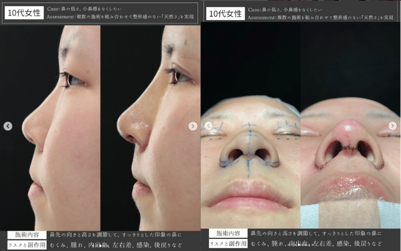 洗濯バサミで鼻は大きくなるのは本当！理由や豚鼻を避ける為の方法も紹介everyday life