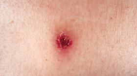 ニキビダニ」ってなに？ – BEBEAURA Store