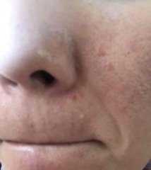 赤ちゃんの体にぶつぶつが出た！原因別の治し方。市販薬は？│医師監修kosodate LIFE 子育てライフ