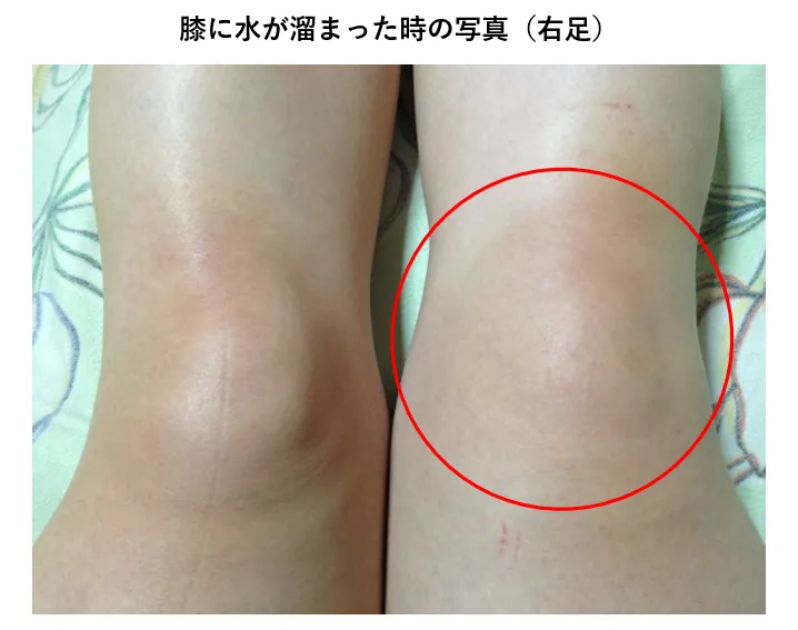 膝の裏が痛い原因は？考えられる病気と治し方・ストレッチ方法を解説