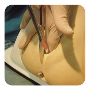 会陰切開の痛みと対策法: リアルな体験談