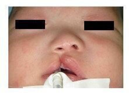 口唇裂・口蓋裂とはなにか―原因不明の場合が多い先天性の異常メディカルノート