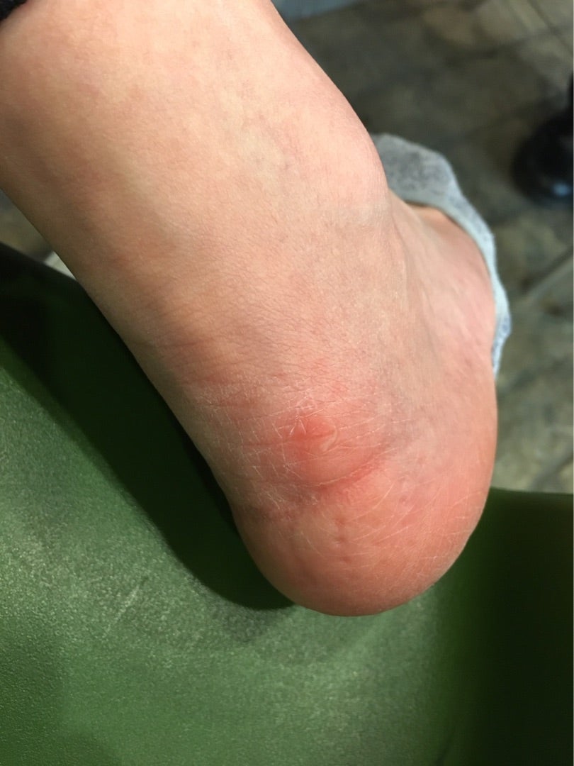 足の水ぶくれ、助けて！！！！ : r martialarts