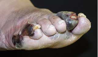 帯状疱疹について - 医療法人清幸会 三原城町病院