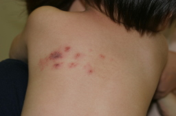 帯状疱疹・単純ヘルペス大宮西口皮フ科形成外科さいたま市大宮区の形成外科・皮膚科