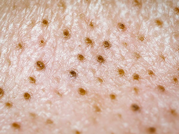 綿棒で毛穴の角栓をドバっと落とす！ワセリン&綿棒の正しい角栓ケア方法ハダメディア by BIHADADO.TOKYO