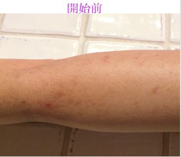 Fotografia do Stock ストレスで腕に湿疹が出る女性Adobe Stock