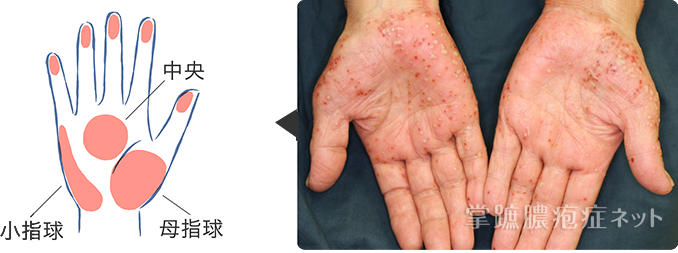 水いぼ ～早く取って治したい方へ～瑞穂ゆかり皮ふ科クリニック瑞穂区の皮膚科・小児皮膚科・美容皮膚科