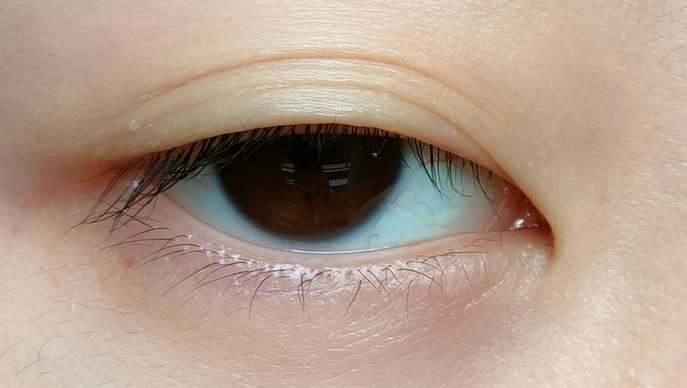 三重まぶたの治し方は？マッサージやアイテープで改善できる？三重になる原因や予防についても解説