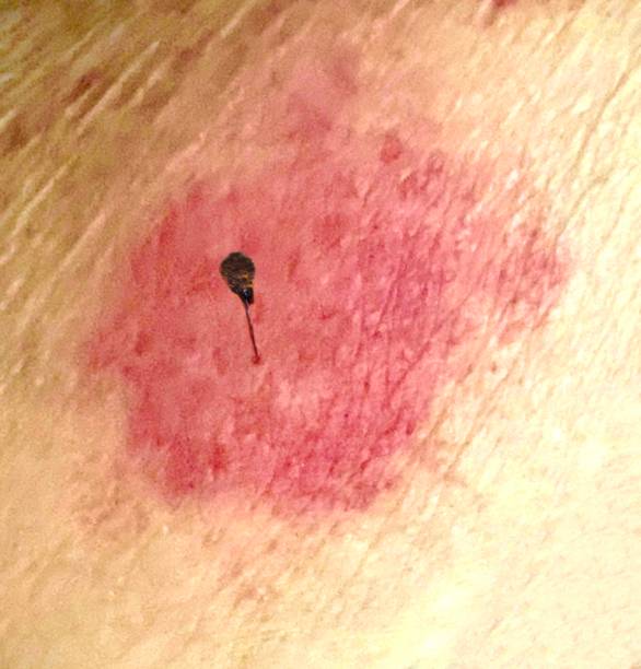 アシナガバチに両手を刺され、腫れてパンパンに膨れ上がってしまった！！ハチの巣に注意！！ 2017-8-2 - イングリッシュガーデン 柴垣グリーンテック