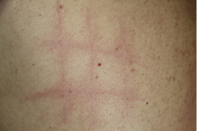 4. アトピー性皮膚炎の症状