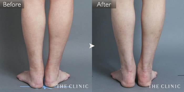 足は使わなければ細くなる！？京都駅近の ヴェリィ美容形成皮フ科クリニック 美容外科・美容皮膚科