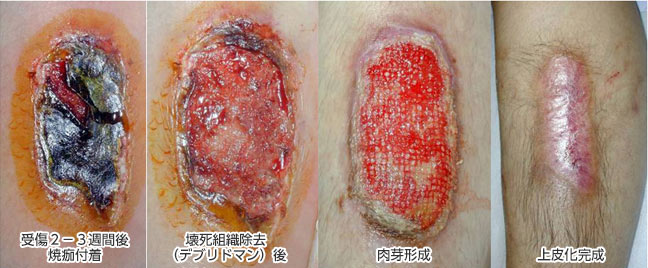 やけどもすり傷もキレイに治る？！～湿潤治療～千葉市稲毛区の内科・小児科・皮膚科・整形外科 ふらットクリニック稲毛