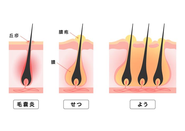 毛嚢炎・めんちょう・おできの市販薬のおすすめ人気ランキング 2025年マイベスト