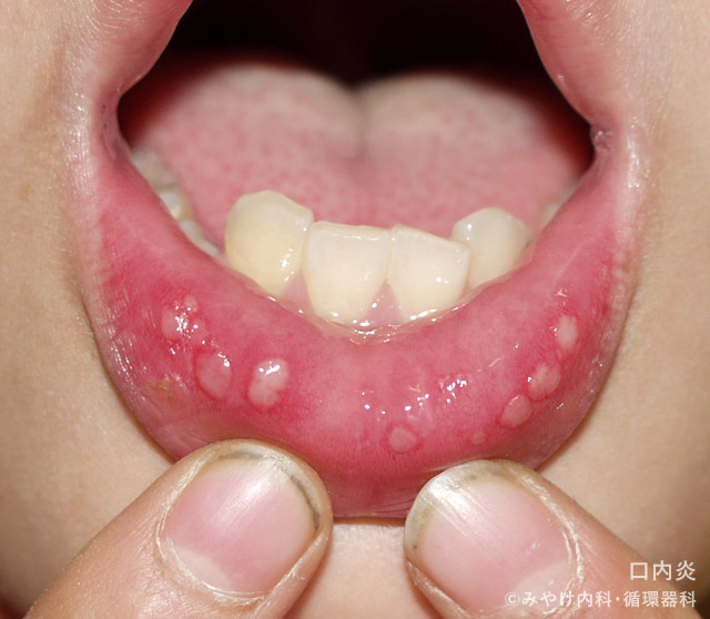 舌の状態で食べ過ぎチェック東陽町歯科医院