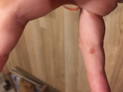 首のイボ 気になりませんか？瑞穂ゆかり皮ふ科クリニック瑞穂区の皮膚科・小児皮膚科・美容皮膚科