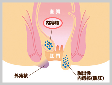 肛門疾患・痔東京都世田谷区の肛門科 鶴町クリニック