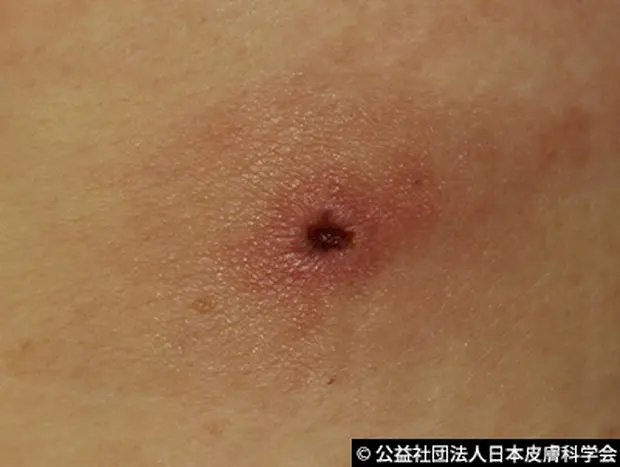 これってダニ刺され？ダニが繁殖しやすい条件や、ダニに刺された場合の対処法を解説