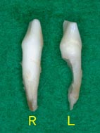 2015年 10月 歯の根っこが溶ける！？ ―歯根吸収―