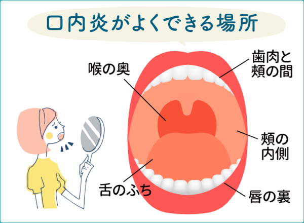 口内炎の治し方とは？口内炎ができてしまったときの対策4選！ 口内炎ならチョコラドットコム