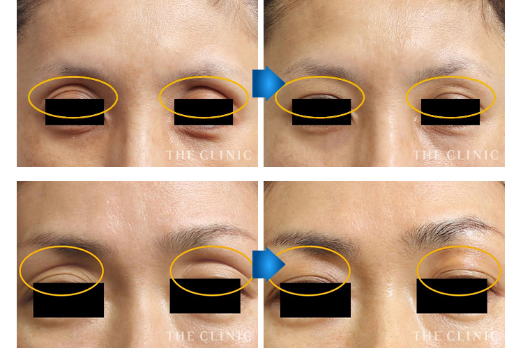 眼瞼下垂がんけんかすい とは済生会