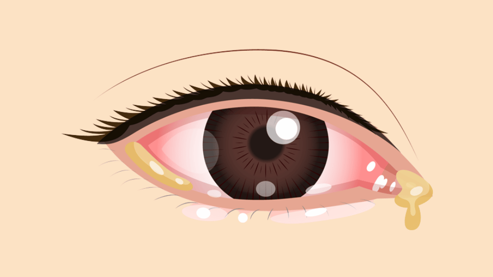 目やにでわかる目やにの原因 細菌性結膜炎？アレルギー性結膜炎？ウイルス性結膜炎？: ある奈良県の眼科医が目について書いたブログ