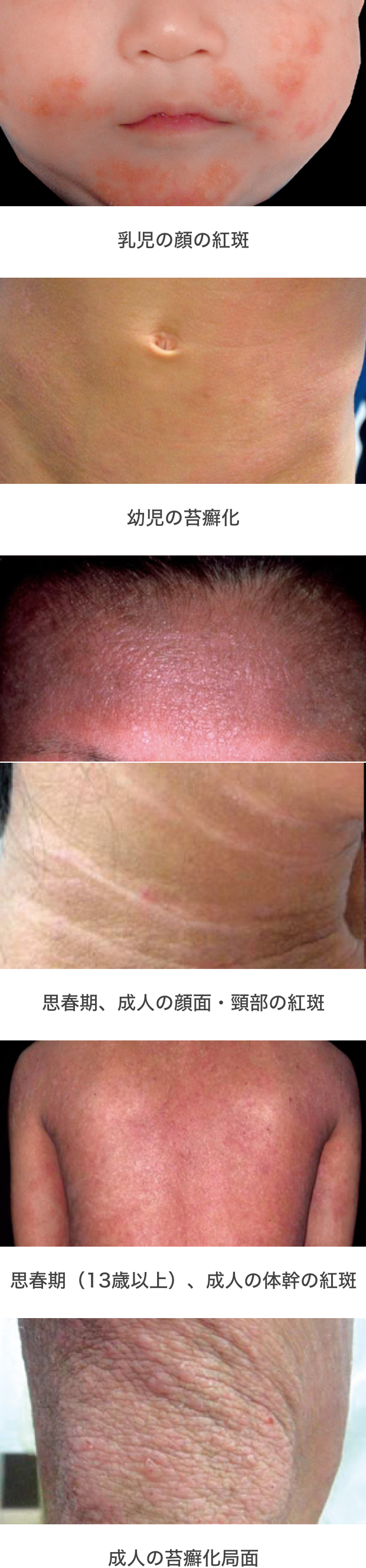 アトピー性皮膚炎』の原因・症状・治療法 症例画像 田辺三菱製薬ヒフノコトサイト