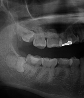 健康な他の歯を守るために千葉市稲毛区 千葉総合歯科稲毛 矯正歯科