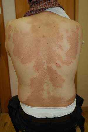 アミロイド苔癬とは？痒みのあるブツブツは発症のサインかもしれませんあさ美皮フ科亀戸駅前