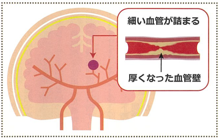 脳梗塞ドクターが教える！病気あれこれ町田市民病院Machida Municipal Hospital