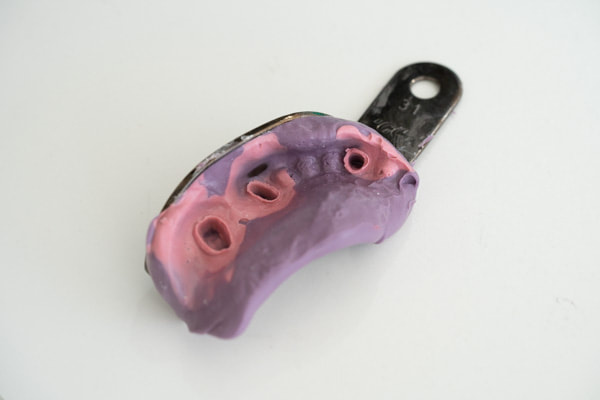 新しいデジタルな歯型取り 光学印象 とは